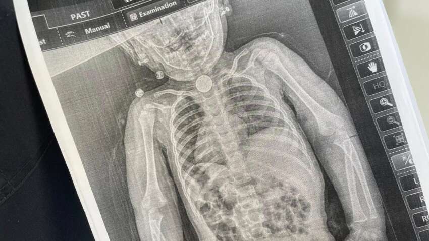 Дворічна дитина у Львові прожила всю зиму з батарейкою у стравоході: що сталося далі