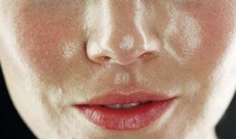 От этих продуктов жирнеет кожа и появляются прыщи