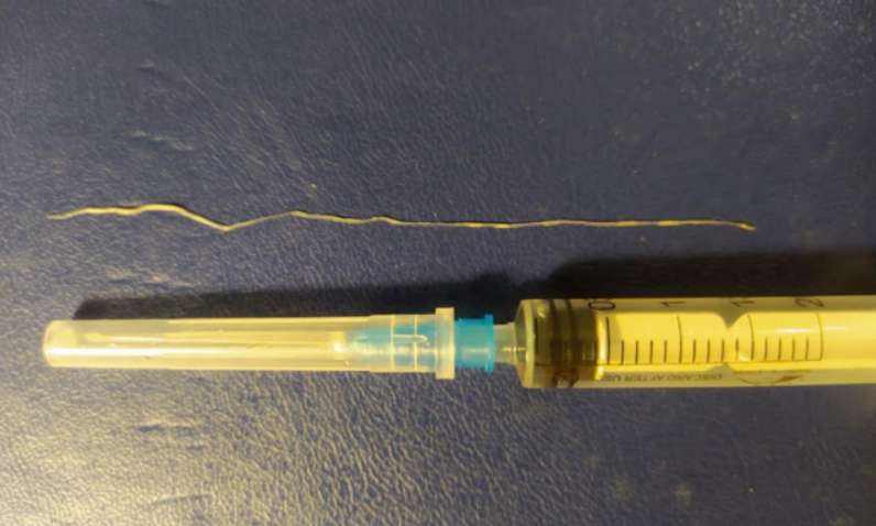 Шевелился под кожей: у женщины вытащили 9-сантиметрового паразита (ФОТО)