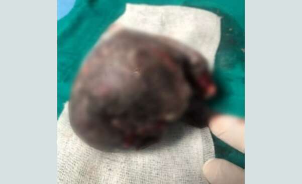 Шоковані лікарі розповіли, що всередині малюка виявили тіло його брата-близнюка