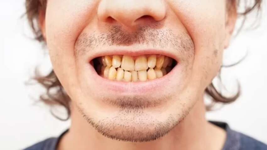 Почему зубы остаются желтыми, даже если вы чистите их каждый день: объяснение стоматолога Почему зубы остаются желтыми, даже если вы чистите их каждый день: объяснение стоматолога