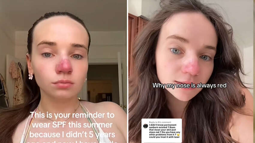 Женщина заснула на солнце и уже пять лет борется с неожиданным эффектом на носе