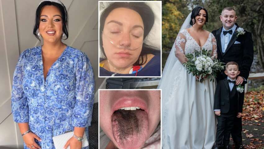 Почорнів язик і операція: несподівані побічні ефекти препарату для схуднення