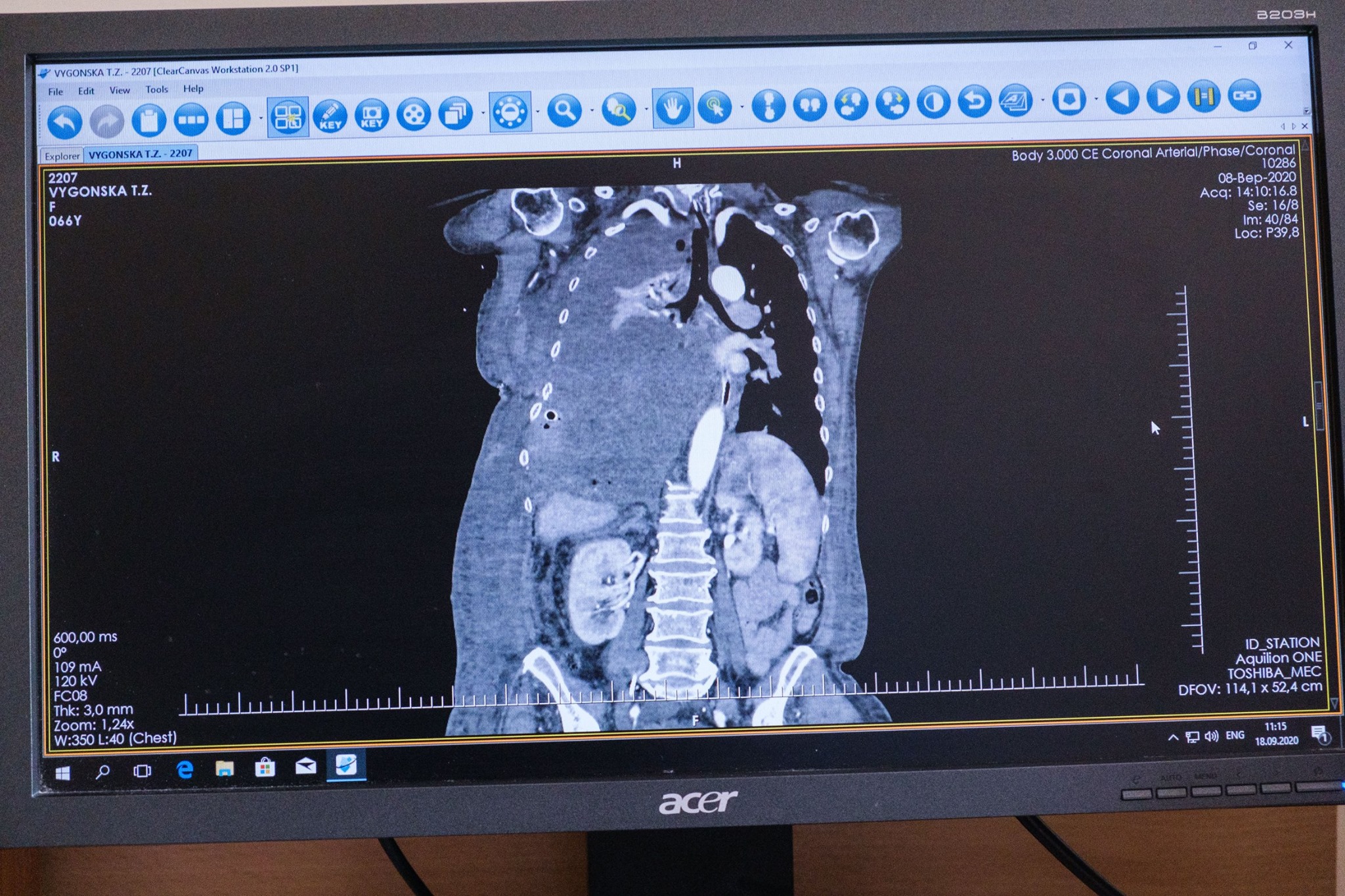 В Україні провели унікальну операцію з видалення пухлини вагою в 4,5 кг - фото 3