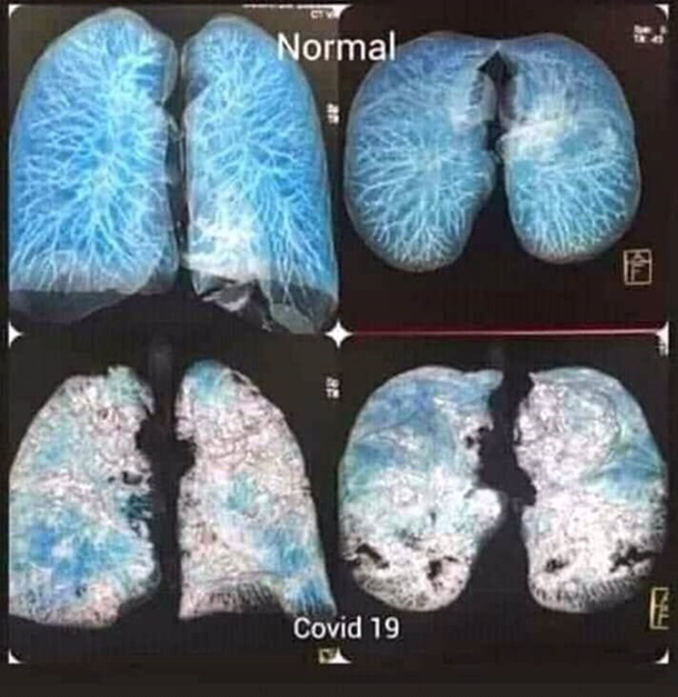 Українські медики показали фото легень, уражених коронавірусом - фото 2