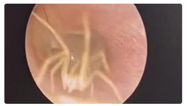 В Китае врач во время осмотра пациентки обнаружил необычную находку в её ухе (ФОТО)  - фото 2