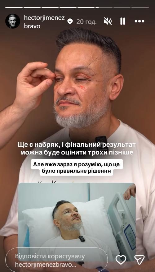 Эктор Хименес-Браво сделал пластическую операцию на лице: показал первые фото - фото 2