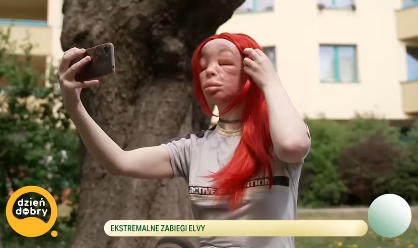 Жінка хотіла покращити зовнішність, але деформувала лице до невпізнання (ФОТО) - фото 2