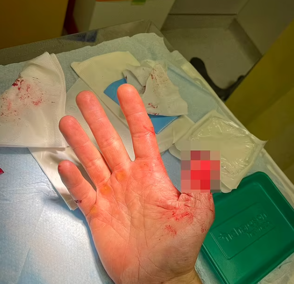 Чоловік стікав кров'ю: доставниця піци відкусила палець клієнту (ФОТО 18+) - фото 2