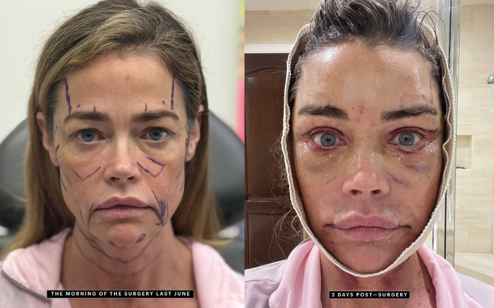 Девушка Бонда Дениз Ричардс сделала пластическую операцию и показала фото до и после - фото 2