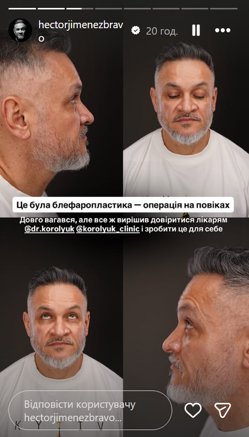 Эктор Хименес-Браво сделал пластическую операцию на лице: показал первые фото - фото 2