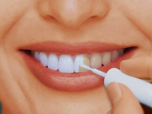Как отбелить зубы от табачного налета