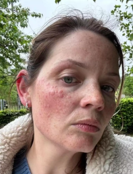 У женщины ”аллергия на зиму”: какие симптомы редкого заболевания (ФОТО) - фото 2