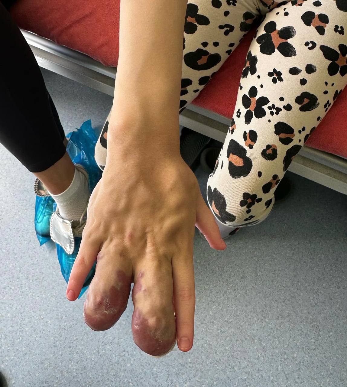 Редкая патология: украинские врачи спасли руку девочке - фото 2