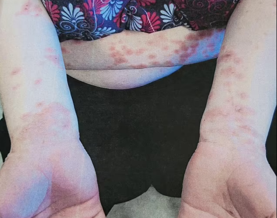 Аллергия на собственную кожу: женщина перестала носить одежду из-за ужасной проблемы - фото 2