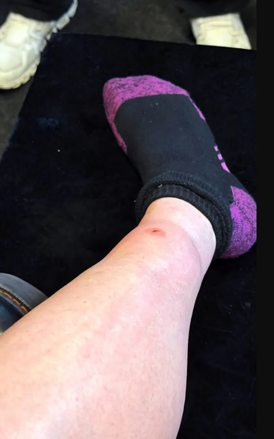 Известную певицу срочно доставили в больницу после укуса ядовитого паука - фото 2