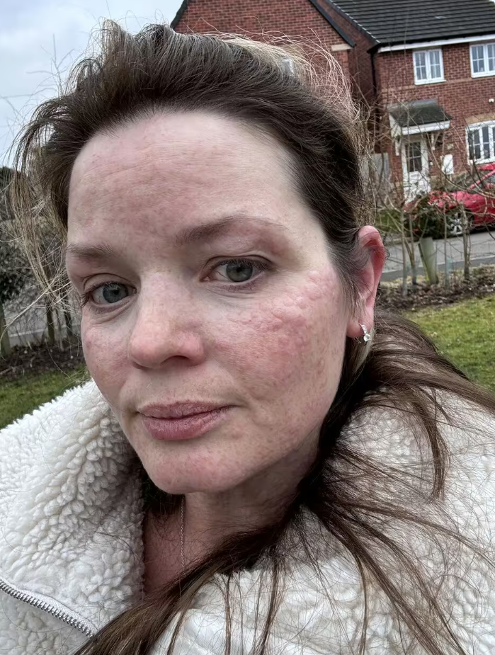 У женщины ”аллергия на зиму”: какие симптомы редкого заболевания (ФОТО) - фото 2