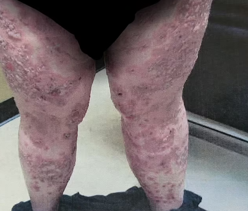 Аллергия на собственную кожу: женщина перестала носить одежду из-за ужасной проблемы - фото 3