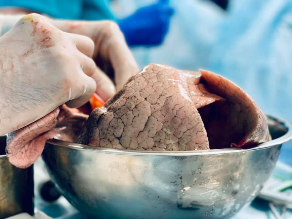 В Украине провели две уникальные трансплантации: как хирурги спасают жизни - фото 4